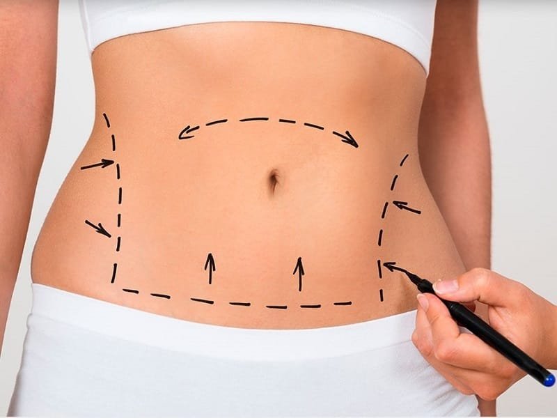 What will the recovery process be like after plastic surgery